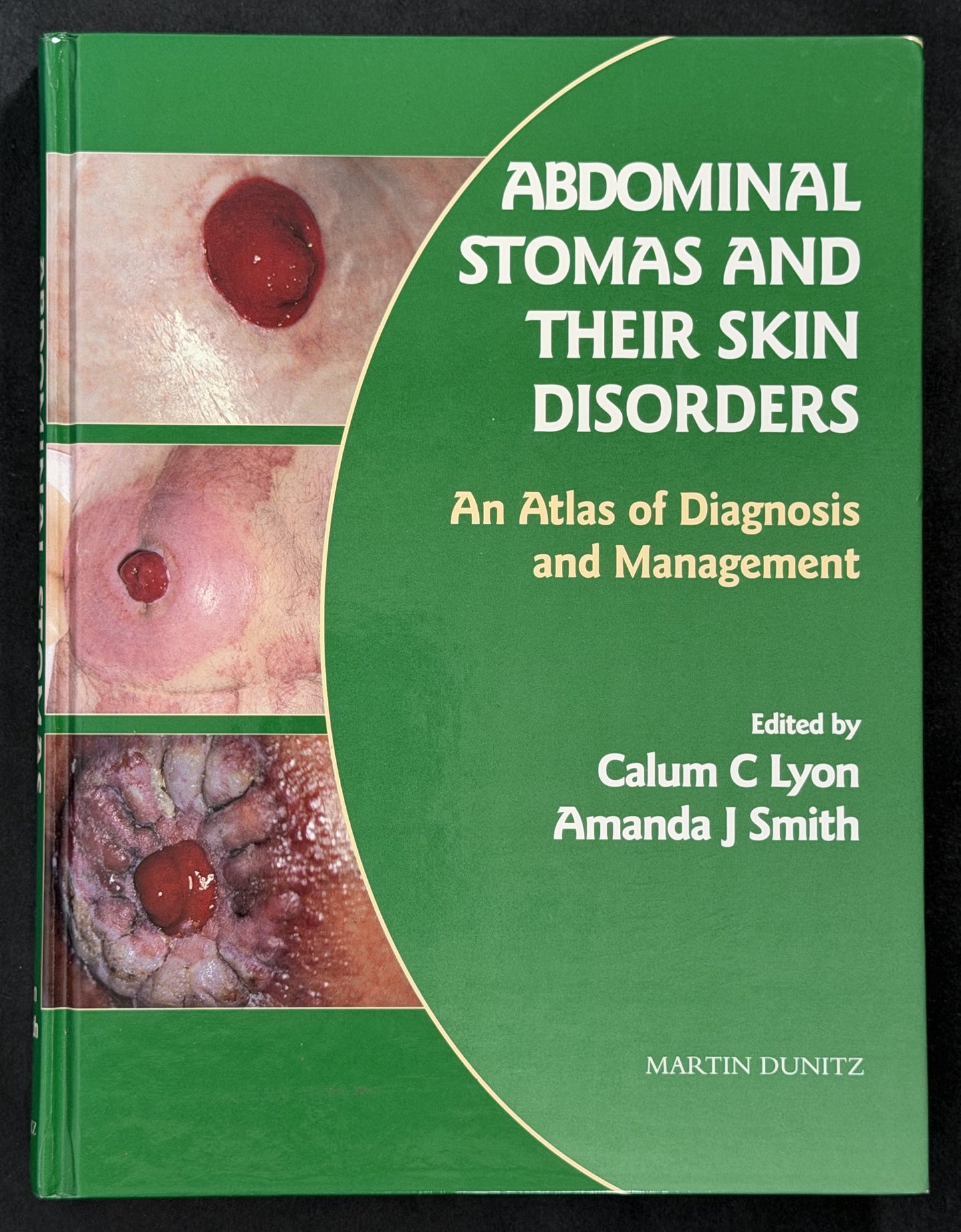 Abdominal Stomas and their Disorders by Calum C Lyon, Amanda J Smith