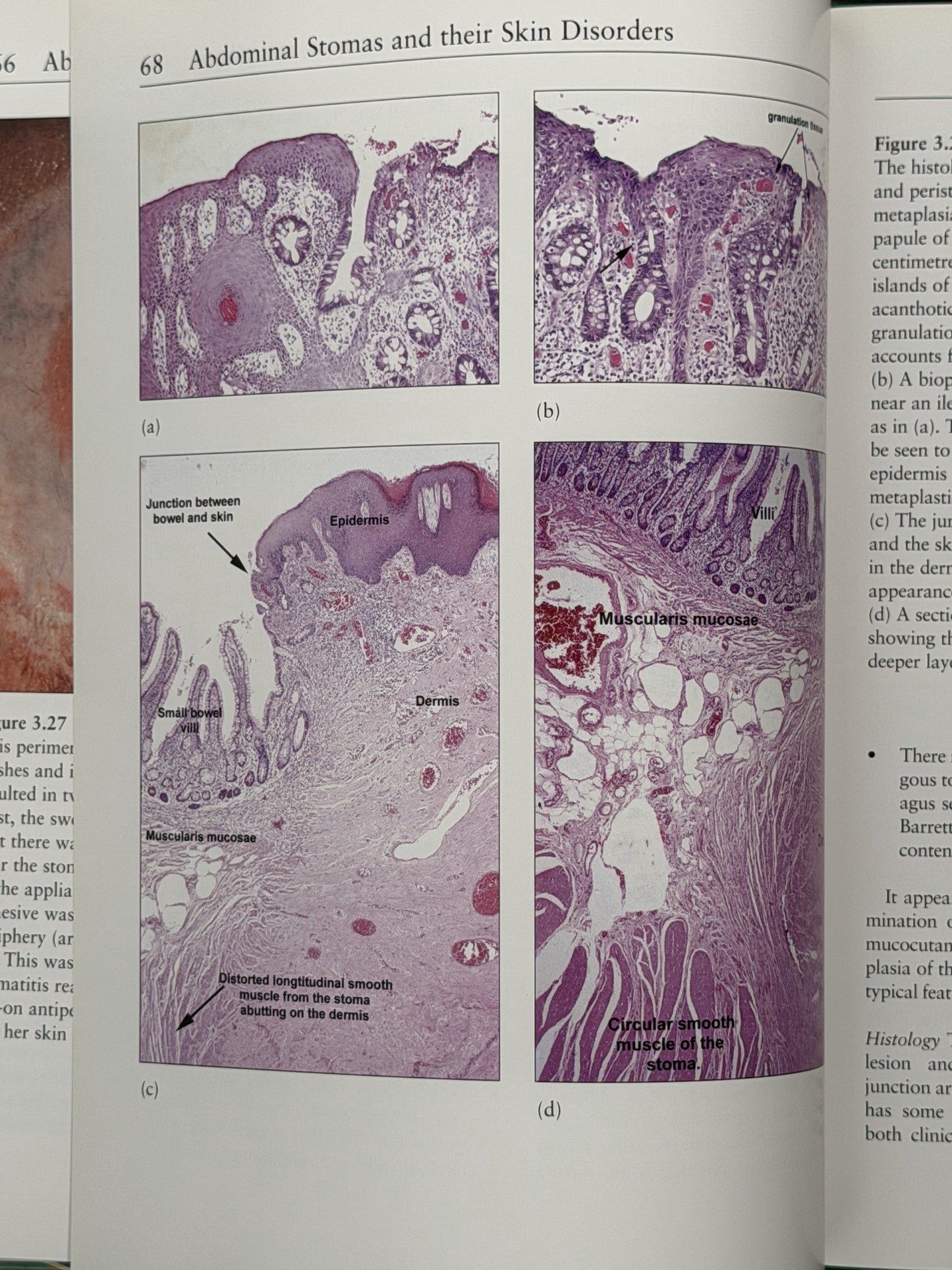 Abdominal Stomas and their Disorders by Calum C Lyon, Amanda J Smith