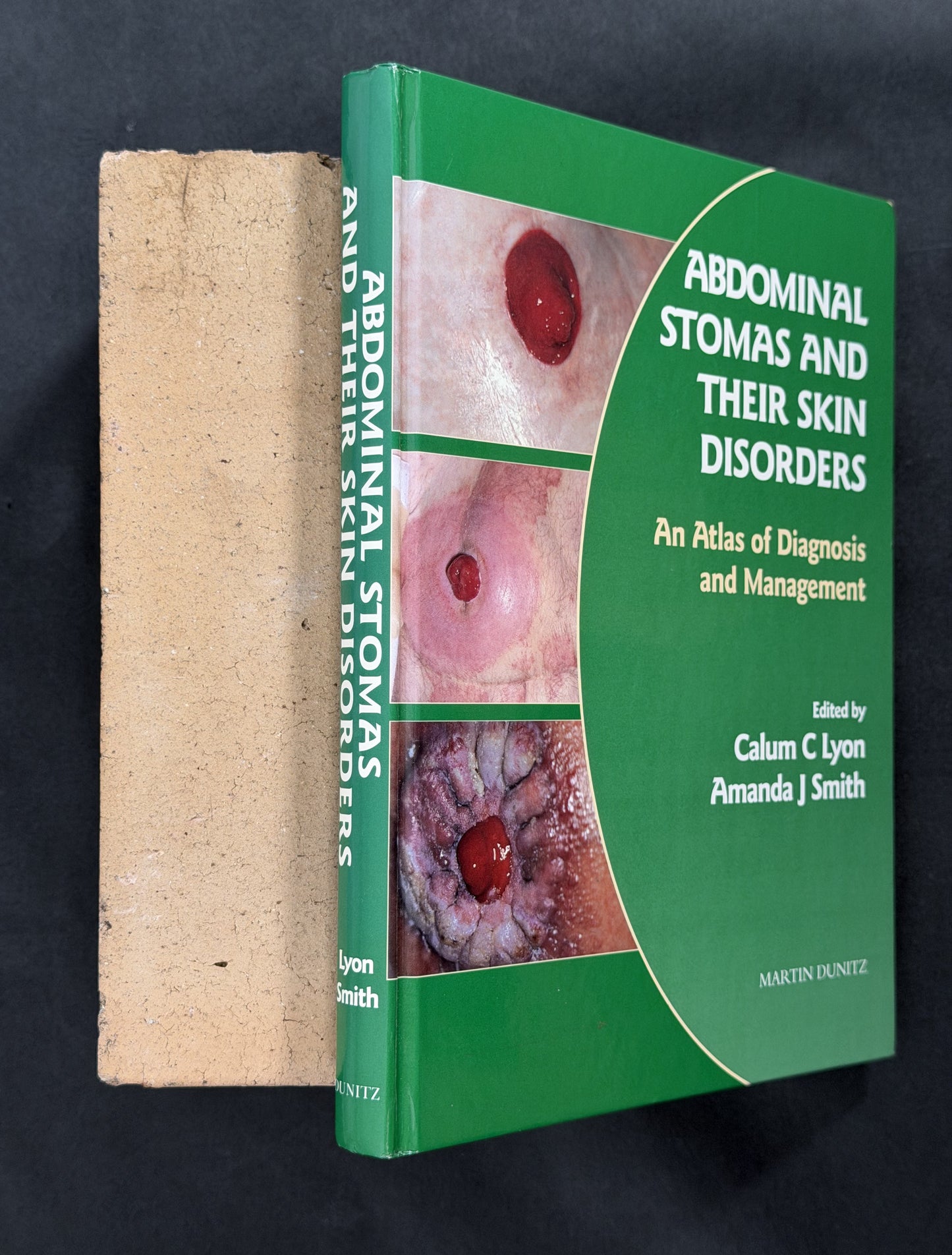 Abdominal Stomas and their Disorders by Calum C Lyon, Amanda J Smith